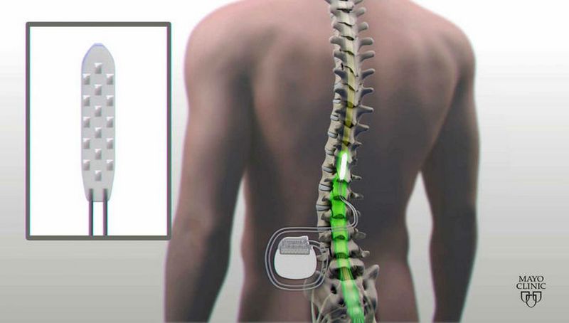 Электростимуляция спинного мозга помогла парализованному человеку вновь начать двигать ногами